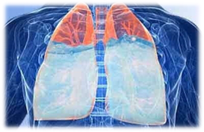 Набряк легень: причини, симптоми та лікування набряку легень